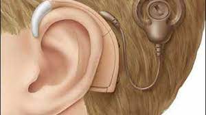 کدام بیماران به کاشت حلزون شنوایی نیاز دارند؟